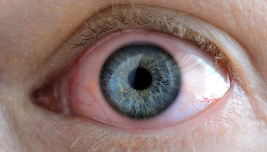 Bunu yaparsanız kornea ülseri olabilirsiniz