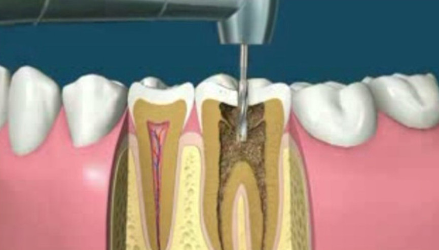 Korkutan kanal tedavisi böyle yapılıyor