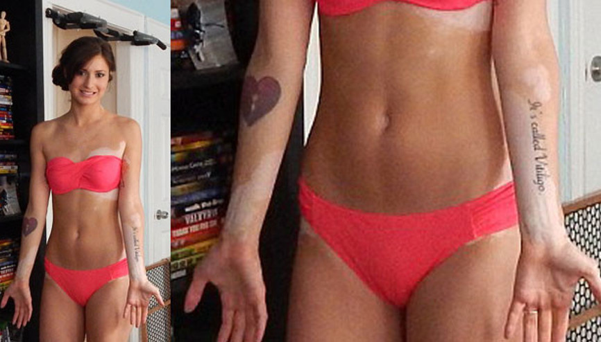 Sorulardan sıkılınca hastalığını dövme yaptırdı