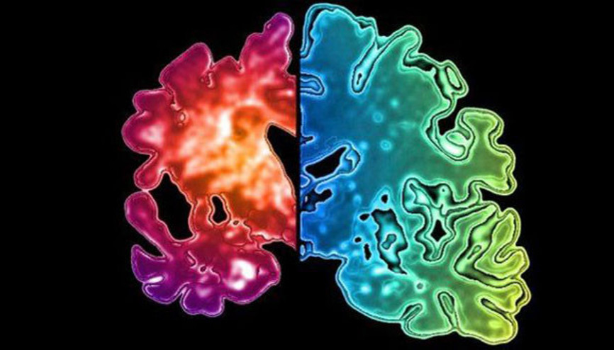 Ameliyat, kan nakli ve diş tedavisinde Alzheimer bulaşabilir
