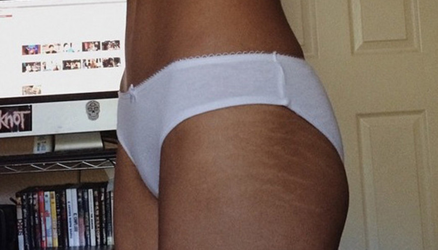 Cilt çatlakları nasıl önlenir