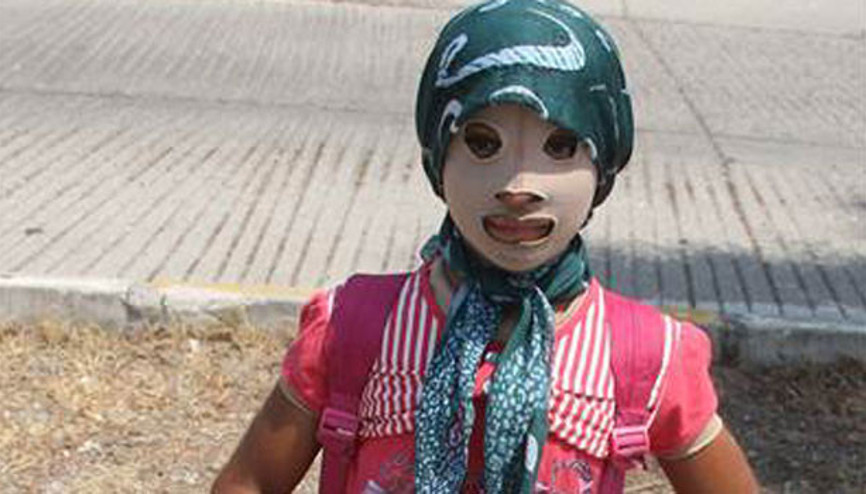 Yüzünde savaşın izlerini taşıyor