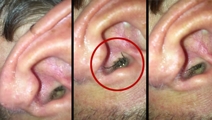 Kulağında örümcek yaşayan adamın dramı