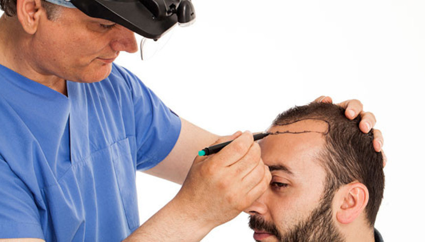 Saç ektirdiğim anlaşılır mı