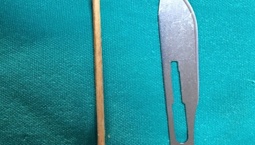 Akciğerinden çıkan kürdan herkesi şaşırttı
