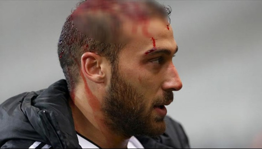 Cenk Tosunda 5 santim kesik 12 dikiş