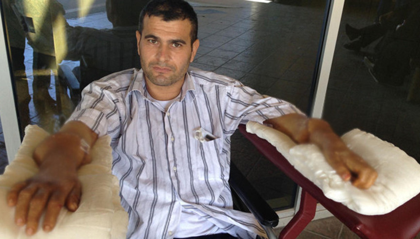 Çift kol nakli yapılan hasta, parmaklarını oynatmaya başladı