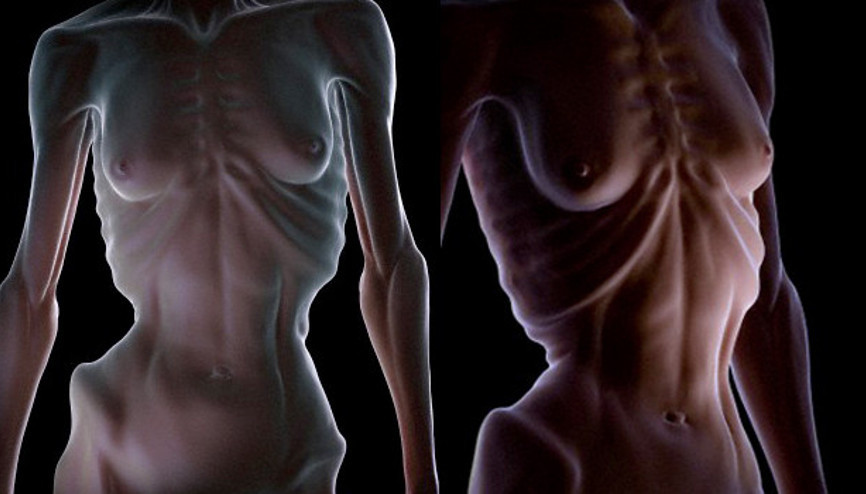 Manken hastalığı ölüme kadar götürüyor