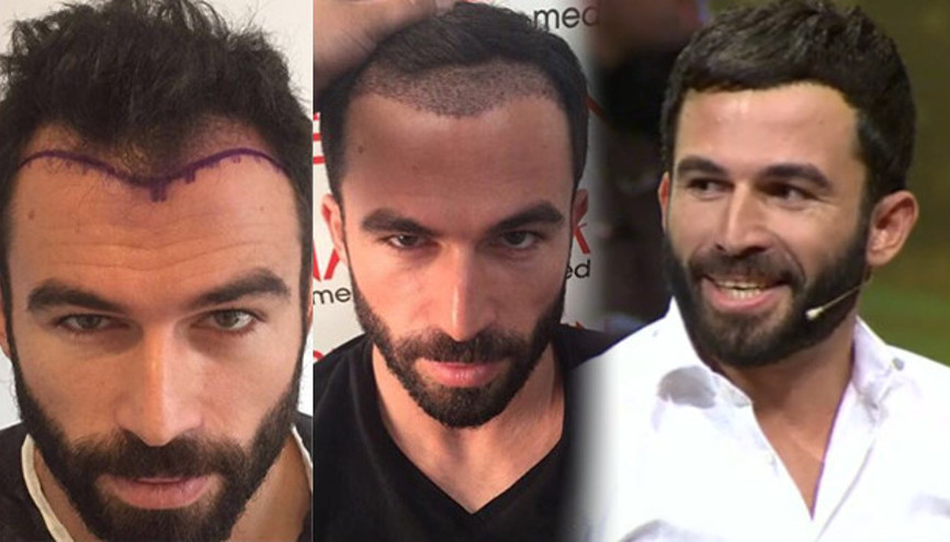 Turabi Çamkıran saç ektirdi