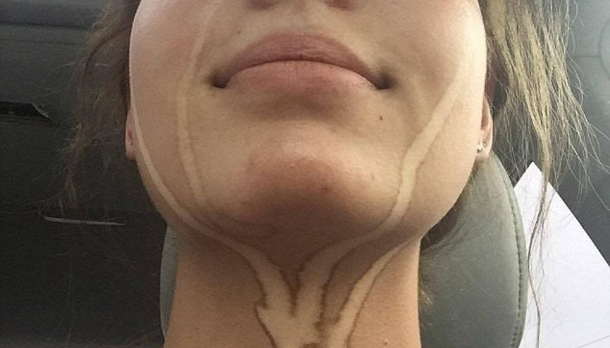 Bronzlaşma faciaları