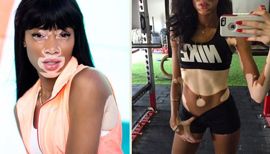 Hastalığını avantaja çevirdi: Winnie Harlow