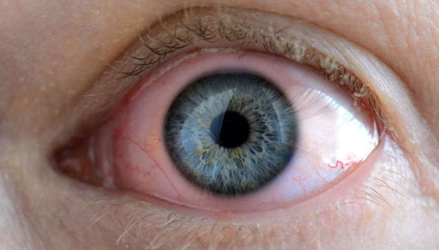 Gözde kırmızılık tehlikeli olabilir