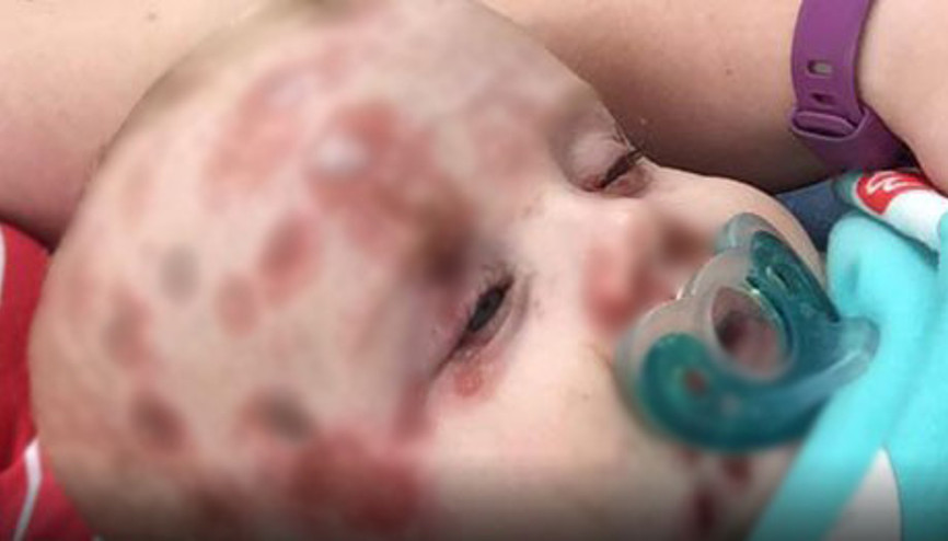 Aşı yaptırılmayan bebek bir başkasına su çiçeği bulaştırdı