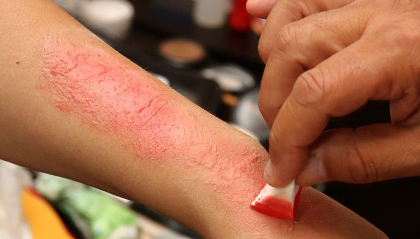 Sedef hastaları ayrımcılığa uğruyor