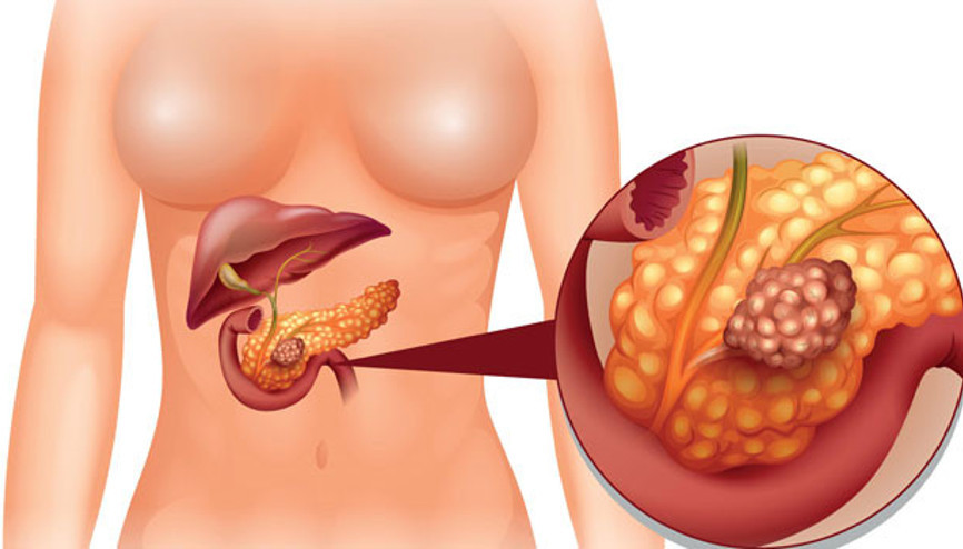 Pankreas kanserine karşı yeni ilaç umudu