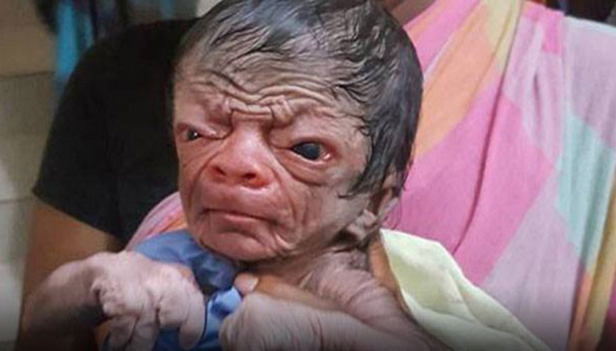 Gerçek Benjamin Button doğdu