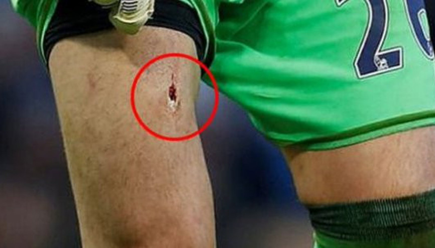 Victor Valdesin maçta bacağı delindi