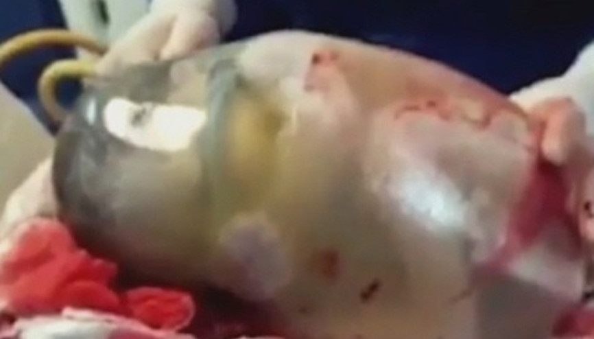 İspanyada bir bebek Amniyon kesesi ile birlikte doğdu