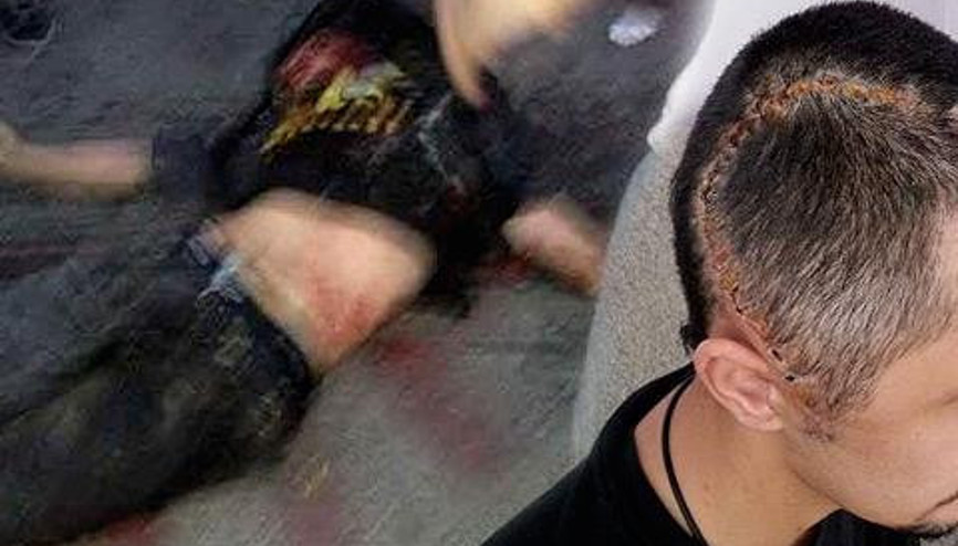 GEZİ OLAYLARINDA AĞIR YARALANMIŞTI.. O GÜN YAŞADIKLARINI BÖYLE ANLATTI