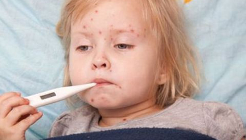 Çocuklarda Kızamık Hastalığı Belirtileri, Teşhisi ve Tedavisi