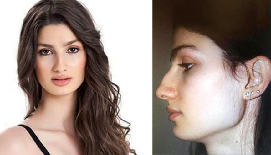 Gizem Kayalı burun estetiği yaptırdı