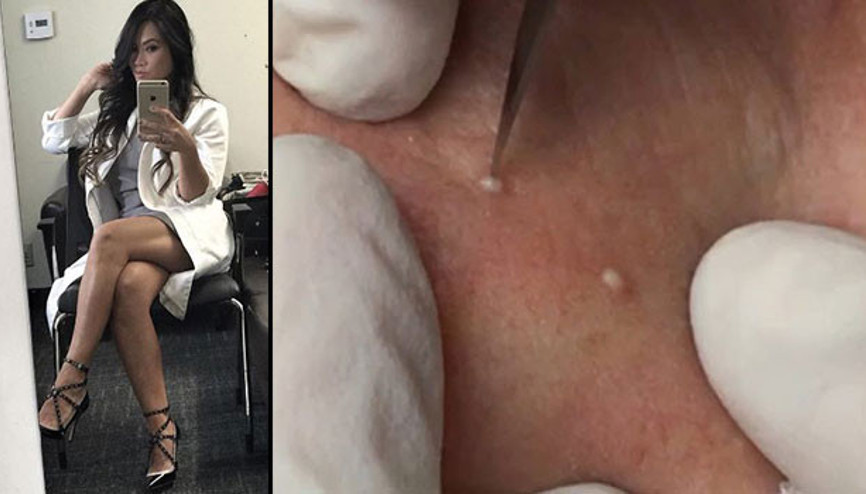 Sivilce sıkarak milyon dolarlar kazanıyor