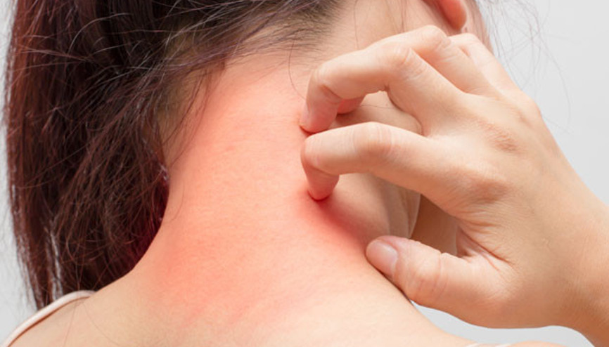 Ürtiker bahar aylarında artıyor Ürtiker bahar aylarında artıyor