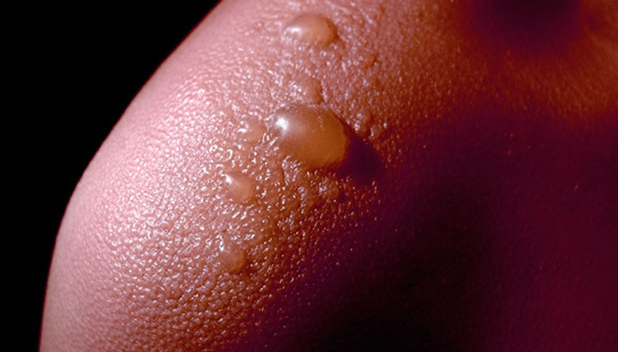 Güneş yanıklarına iyi gelecek 6 doğal yöntem