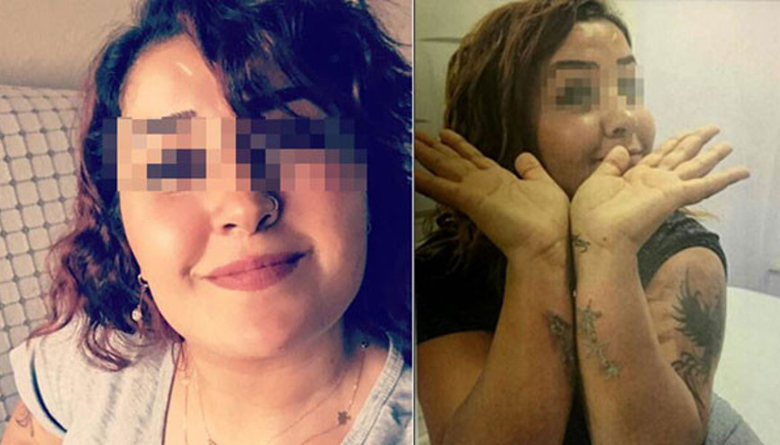 Dövme sildirmek isterken kabus...