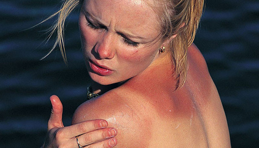 Güneş yanığı cilt kanseri sebebi