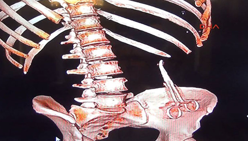 Ameliyatta karnında unutulan makasla 6 ay yaşadı Ameliyatta karnında unutulan makasla 6 ay yaşadı