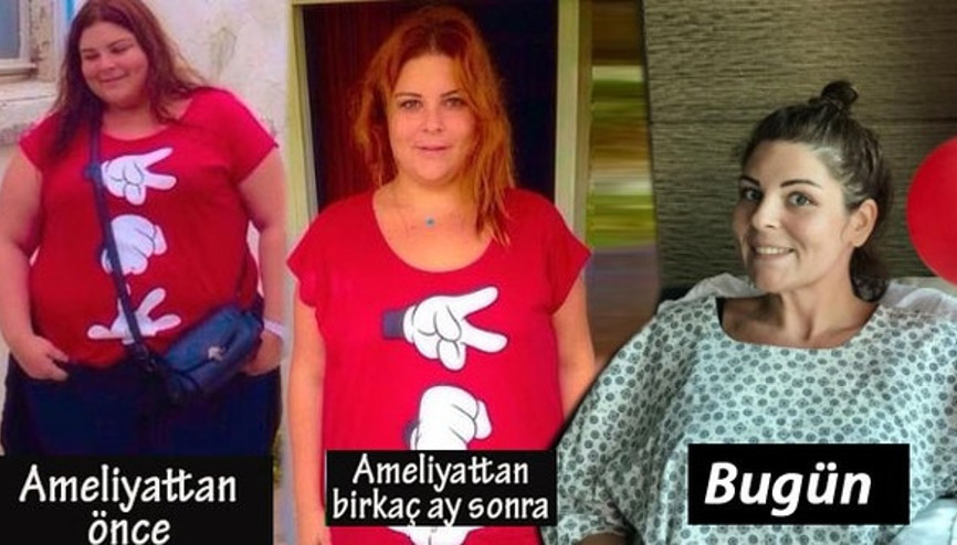 22 ayda 90 kilo veren Pelin Öztekin yeniden ameliyat oldu