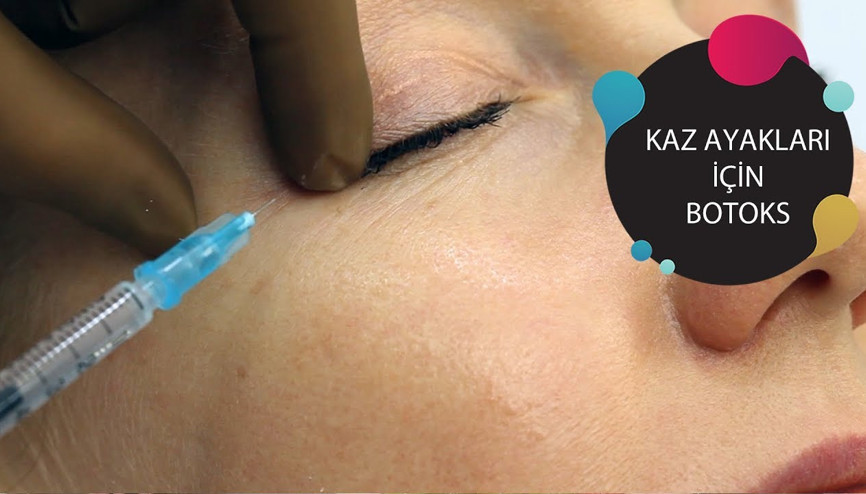 Kaz Ayağı Botoksu | Kız Kulisi