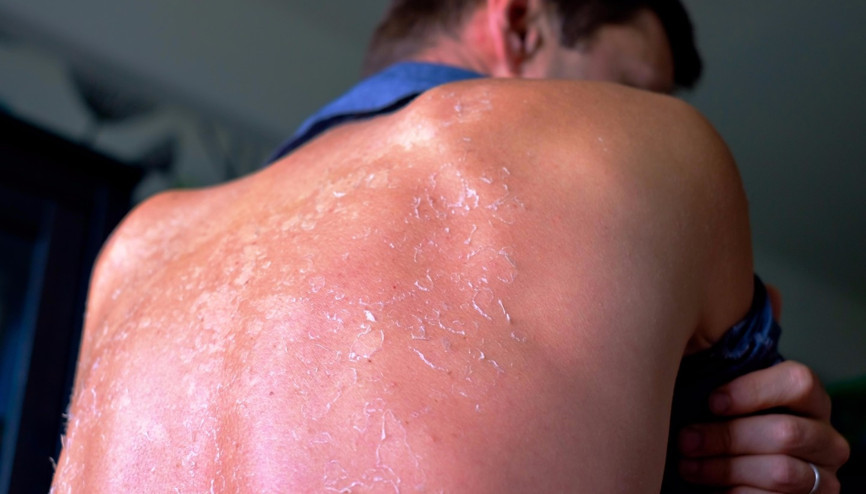 Güneş yanıkları kabusunuz olmasın