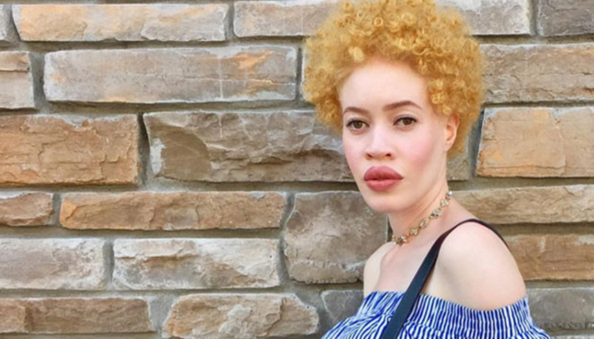 Dünyada bir ilk: Albino model makyaj markasının yüzü oldu