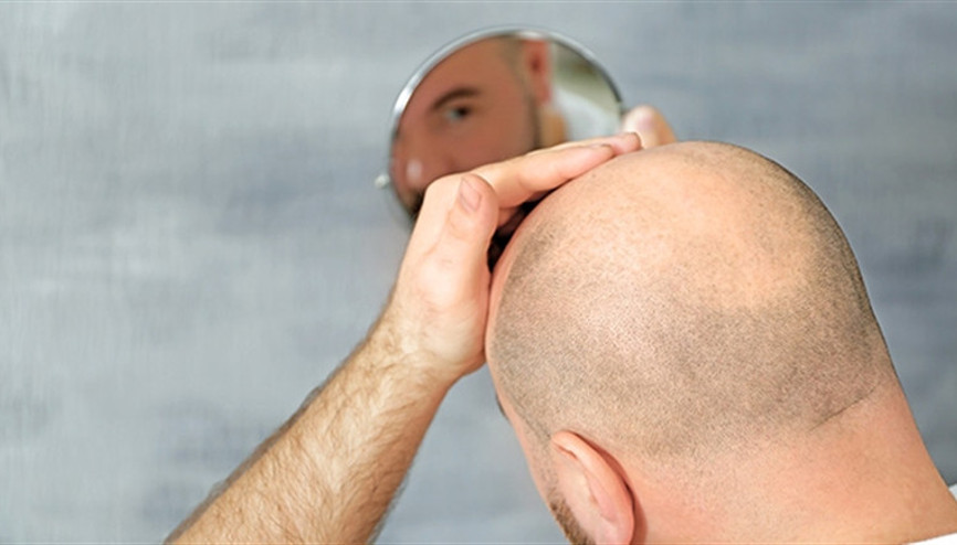 Saç ekimi kişiye özel planlanır