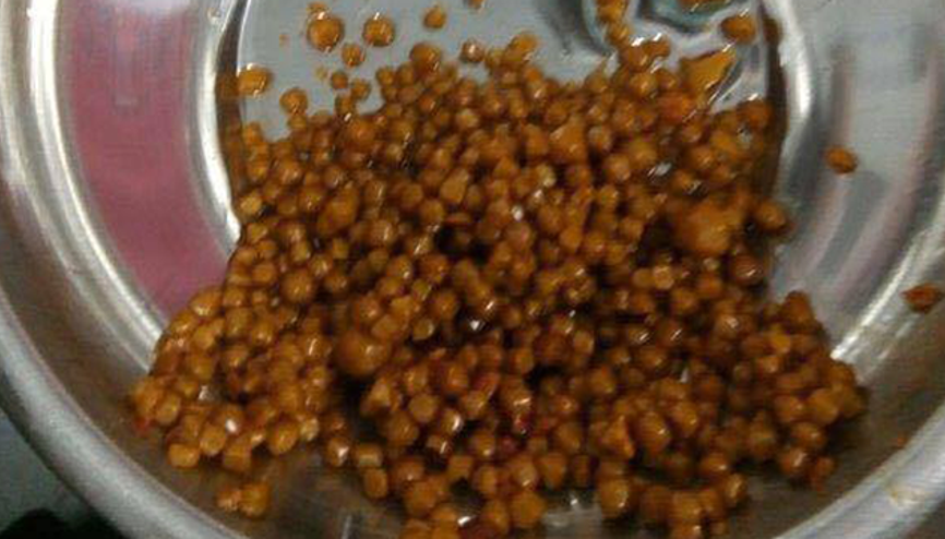 Safra kesesinden 710 taş çıktı