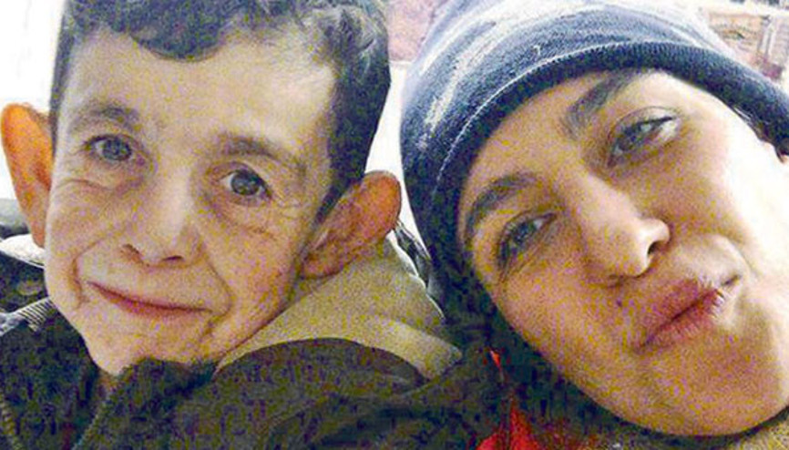 Suriyeli ‘Benjamin Button’ın hayatı  bir fotoğrafla nasıl değişti