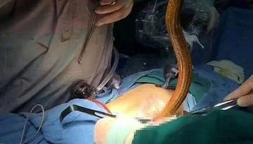 Anüsünden yılan balığı çıktı