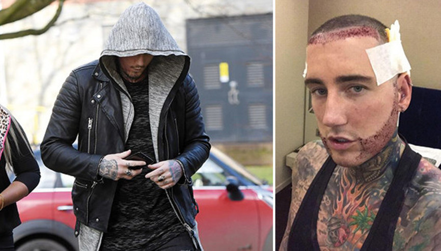 Ünlü yıldız Türkiye’ye saç ektirmeye gelince başına büyük iş aldı