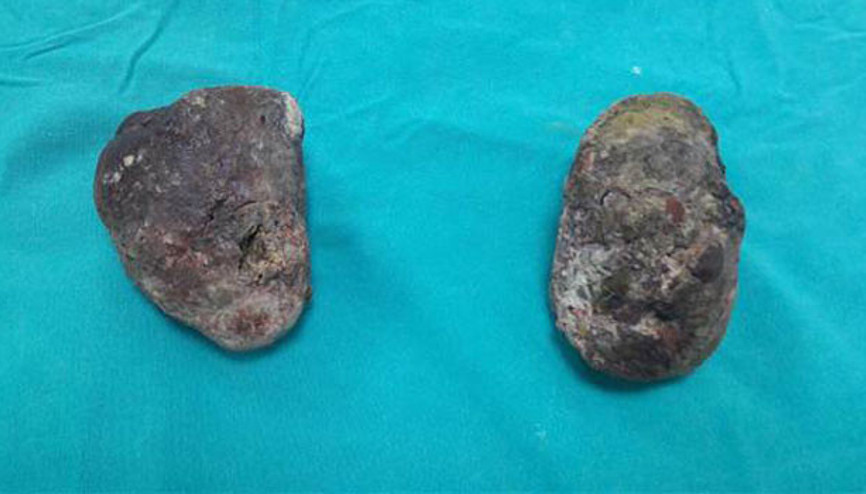 1,5 kilo Trabzon hurması yiyince... Midesinden iki taş çıkarıldı