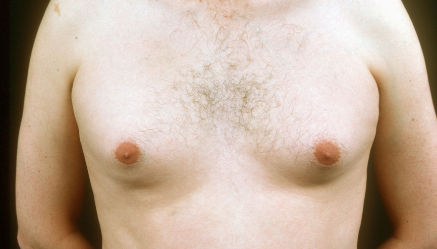 Erkeklerde meme büyümesine dikkat