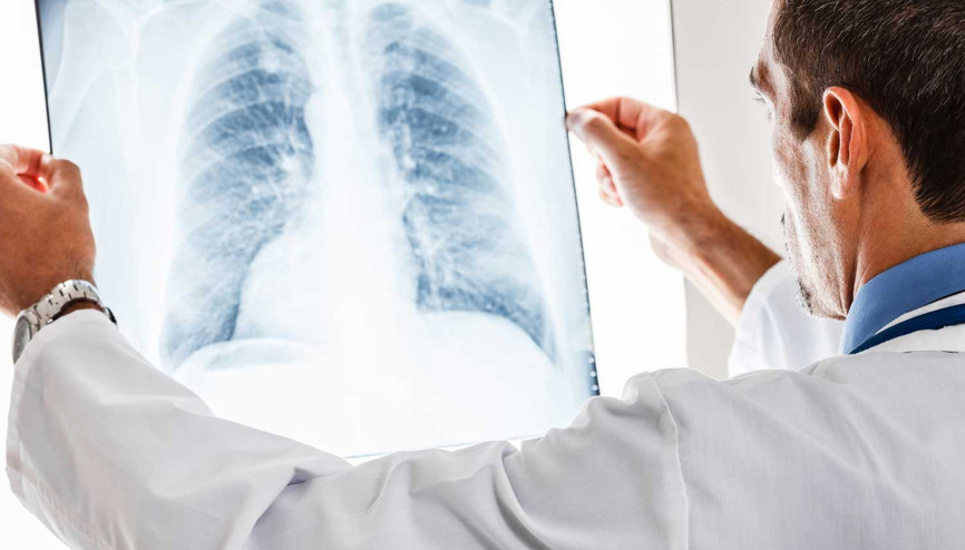 Zatürre nedir Zatürre hastalığı bulaşıcı mıdır