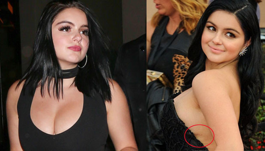 Herkes göğüslerini küçülttürüyor