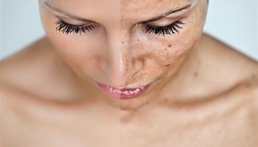 Cilt Lekelerinizden Kurtulmak İçin 8 Pratik Öneri