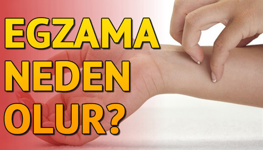 Egzama nedir Neden olur ve nasıl geçer