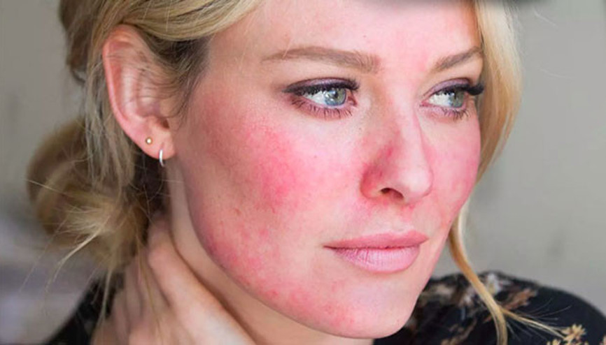 Rosacea (Gül hastalığı) nedir