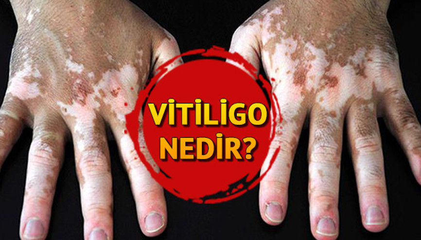 Vitiligo nedir Vitiligo belirtileri ve tedavisi
