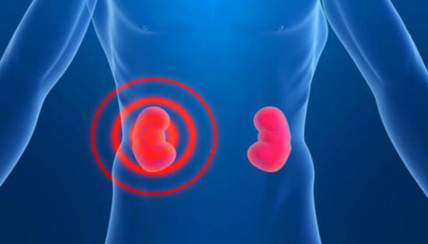 Böbrek tümörü nedir