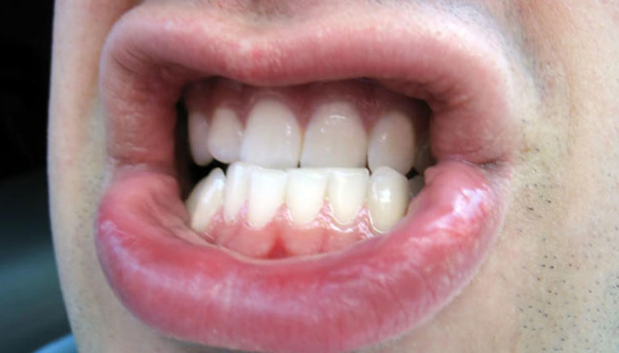 Uykuda diş sıkma neden olur Uykuda diş sıkma tedavisi Uykuda diş sıkma neden olur Uykuda diş sıkma tedavisi